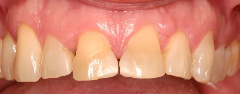 Photo before Tooth Veneers treatment